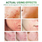 Acne Treatment Serum Facial Repair Oil